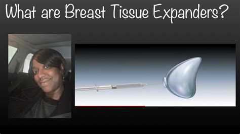 Breast Tissue Expander: What is It & Complications